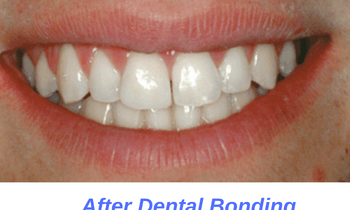 After-Dental-Bonding