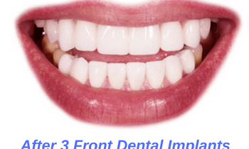 After-Dental-Implants