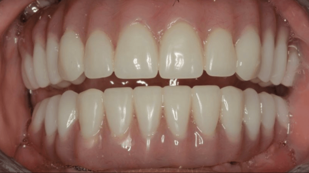 All-on-4 Dental Implants in NYC - Implant Dentures - Manhattan NY