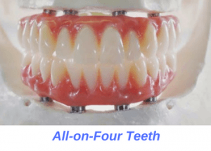 all-on-four-teeth