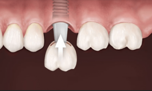 dental-implant-bridge