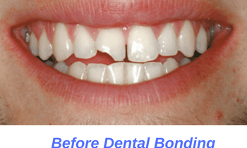 Before-Dental-Bonding