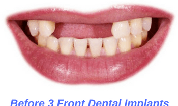 Before-Dental-Implants