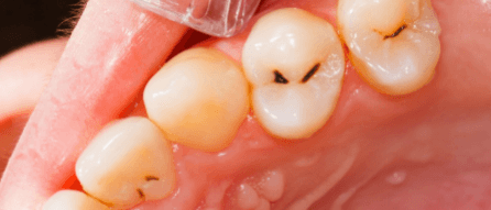 before-dental-fillings