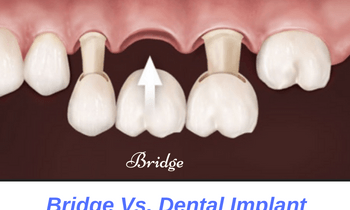 bridge-versus-dental-implant