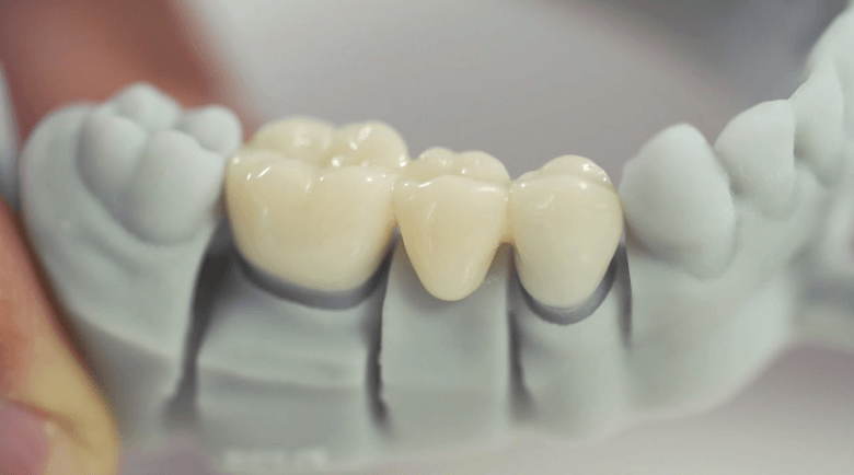 dental-bridge-san-clemente