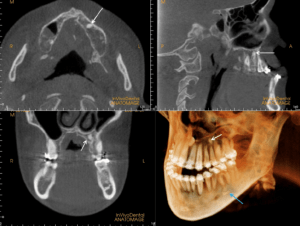 CBCT Scan