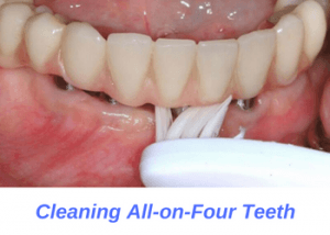 Cleaning-all-on-four-implants