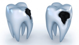 dental-cavities