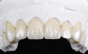 cosmetic-dental-crowns