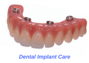 cleaning-dental-implants