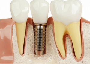 dental-implant-material