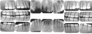 Periapical-bitewing-xrays