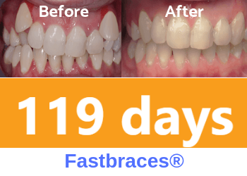 fastbraces-teeth-crowding