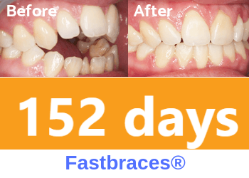 fastbraces-open-bite