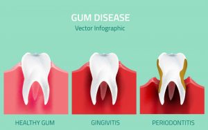 gum-disease-gingivitis-periodontitis