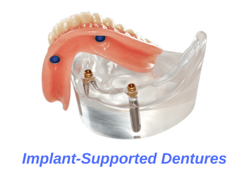 Implant-Supported-Denures-Overdentures