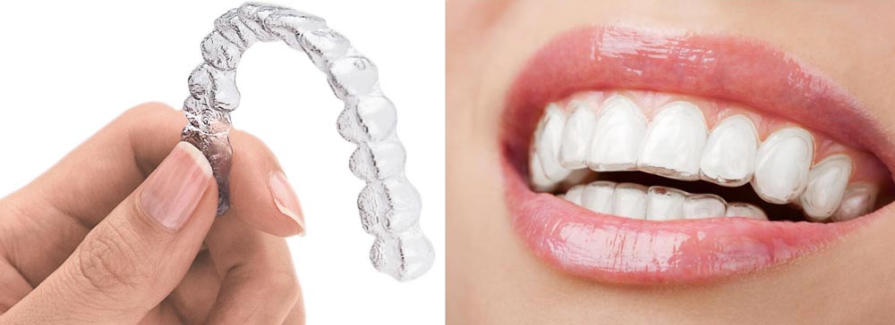 invisalign-clear-aligners-benefits