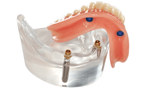 implant-supported-dentures