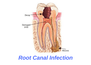root-canal-treatment