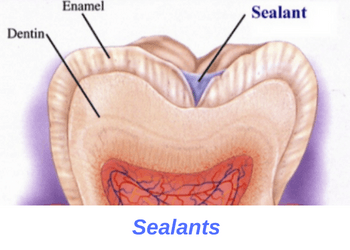 dental-sealants