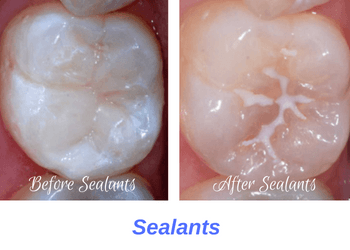 dental-sealant-procedure