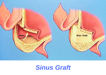 Sinus-Lift-Graft