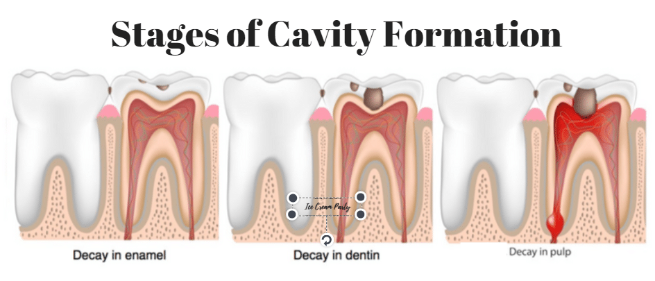 satges-dental-cavity