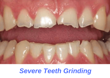heavy-teeth-Grinding