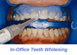 dentist-professional-teeth-whitening