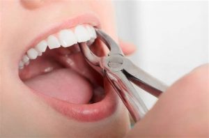 wisdom-teeth-extraction