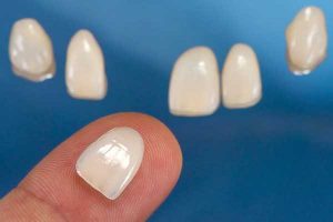 porcelaIn-veneers-benefits