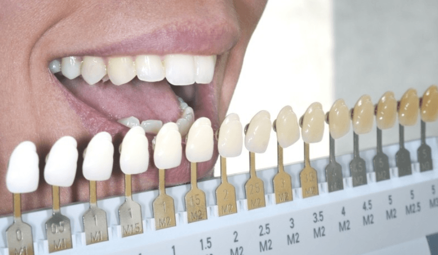 Teeth-whitening-candidate