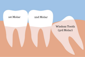 Impacted-wisdom-teeth