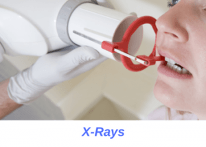 Xrays