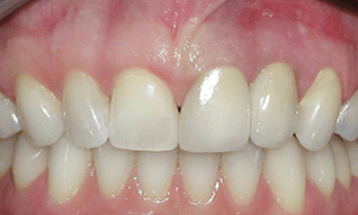 after-dental-bridge