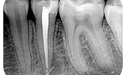 after-root-canal-treatment