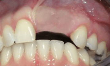 before-dental-bridge
