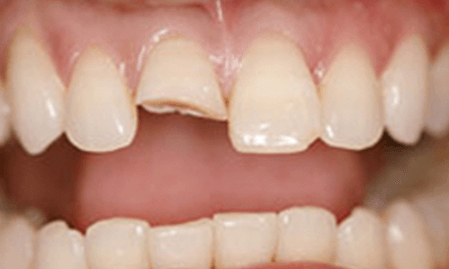 before-dental-crown