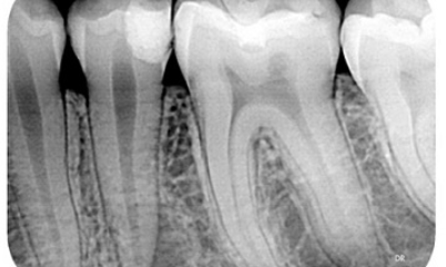 before-root-canal-treatment