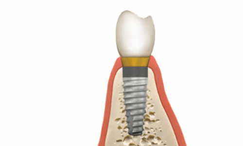 bone-graft-dental-implant