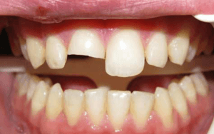 dental-bonding-limitations