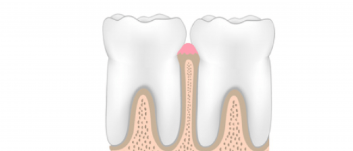 dental-cleaning-simple-cleaning