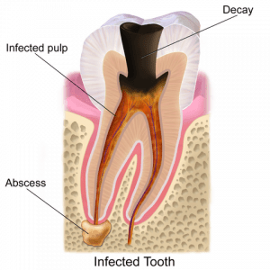 dental-emergency-tooth-infection