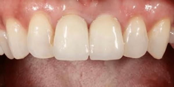 dental-implant-after-1-san-clemente