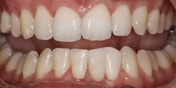dental-implant-after-2-san-clemente