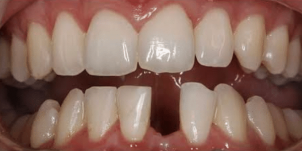dental-implant-before-2-san-clemente