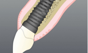 immediate-dental-implant-after