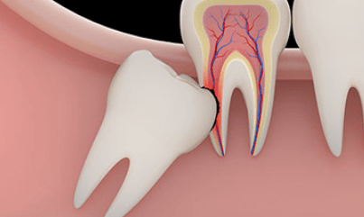 impacted-wisdom-teeth