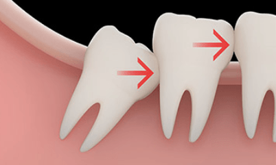 impacted-wisdom-teeth-crowding